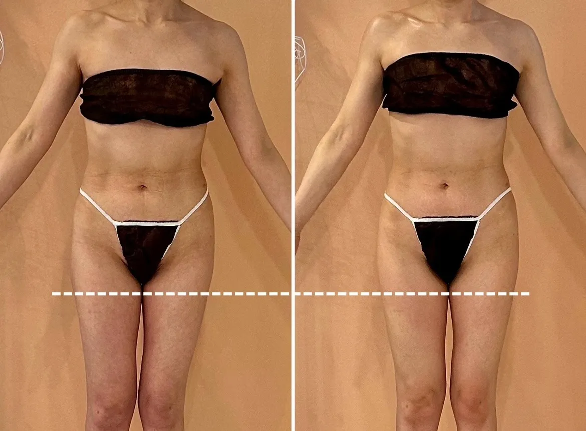 瘦身5回コース・一回目40代