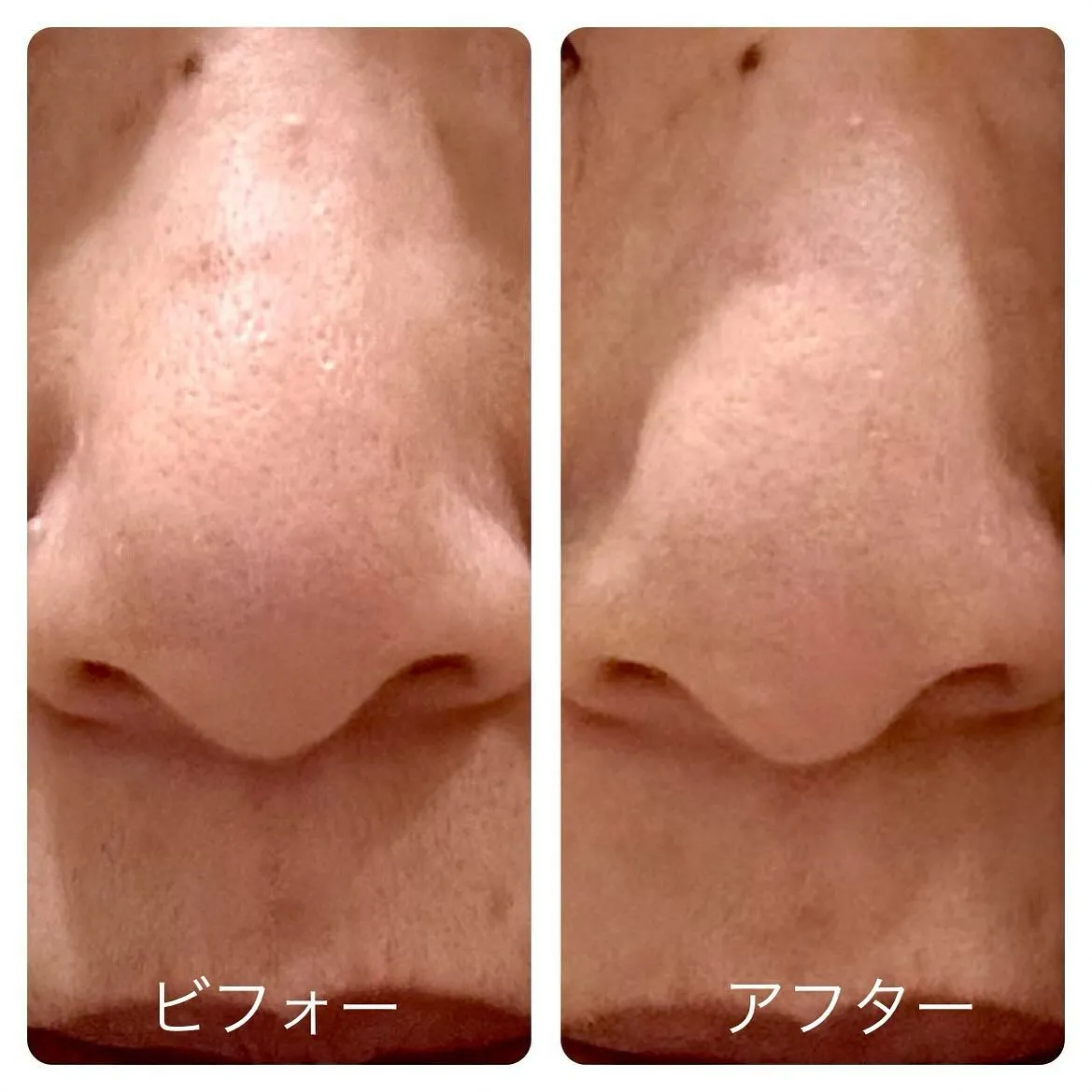 ハーバルピーリン体験