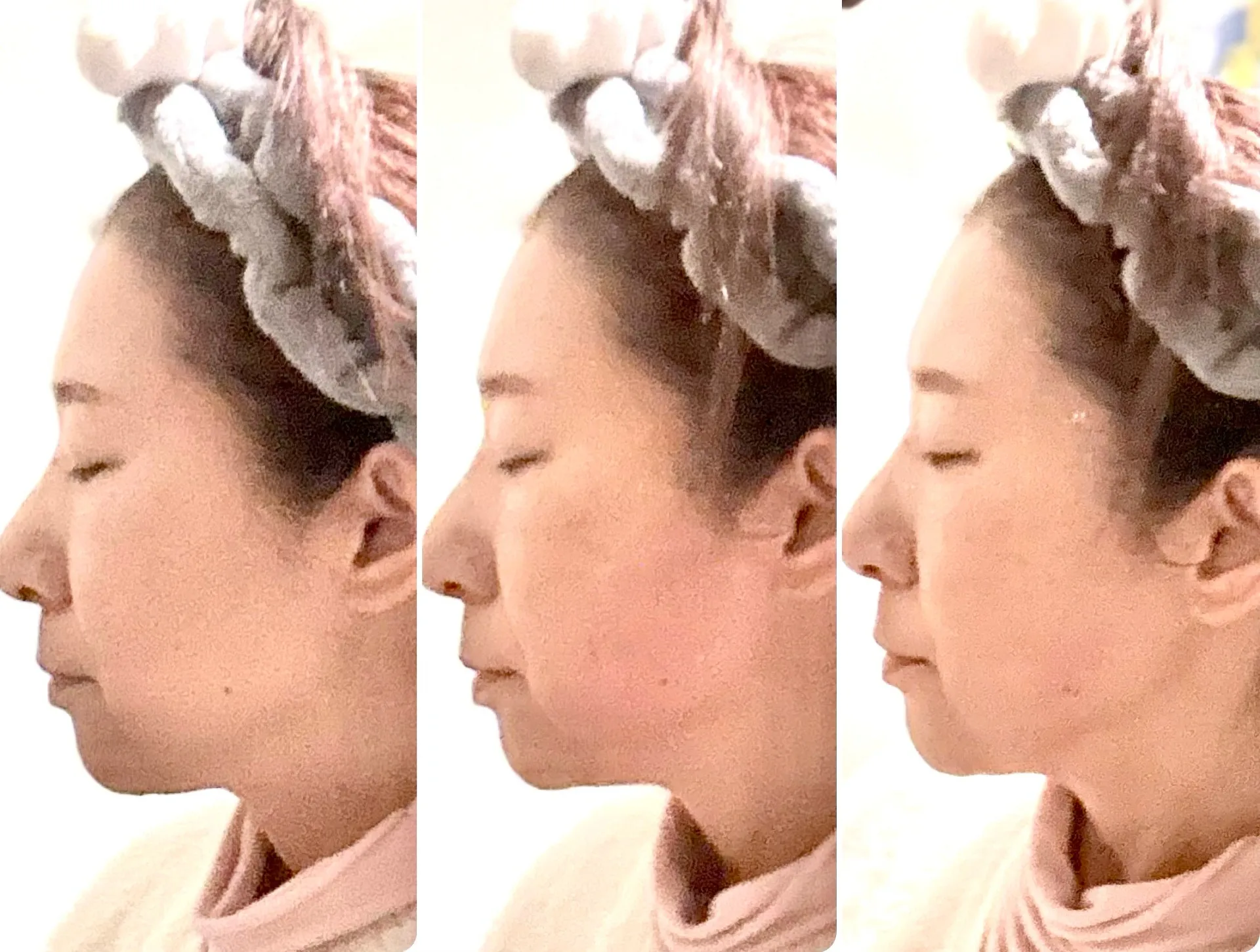 レモンボトル一回施術